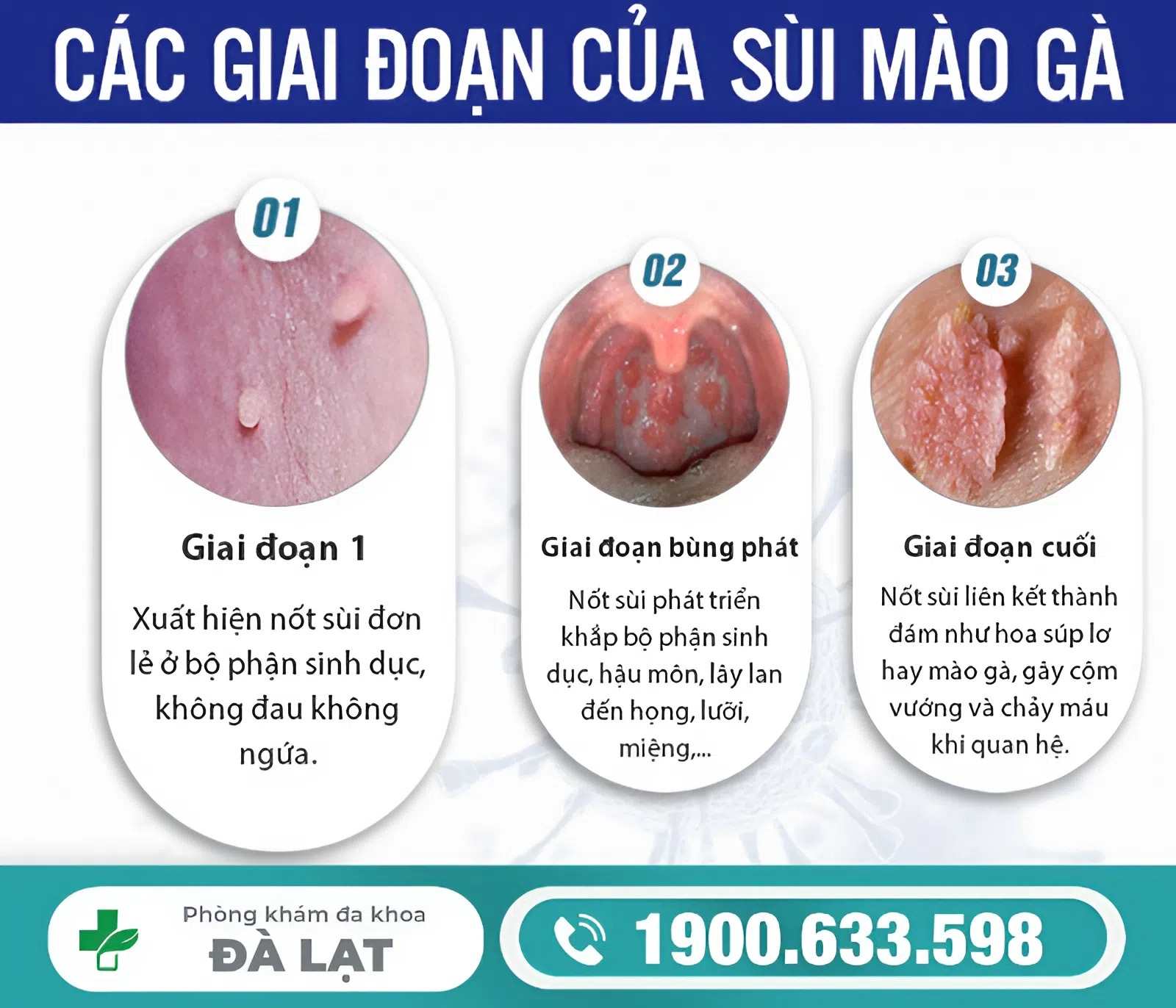 BIỂU HIỆN BỆNH SÙI MÀO GÀ Ở NAM GIỚI 